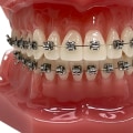 The Benefits Of Using Tens In Dentistry For Braces Patients In Austin, TX
