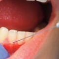 How Long Does a TENS Treatment Last in Dentistry?